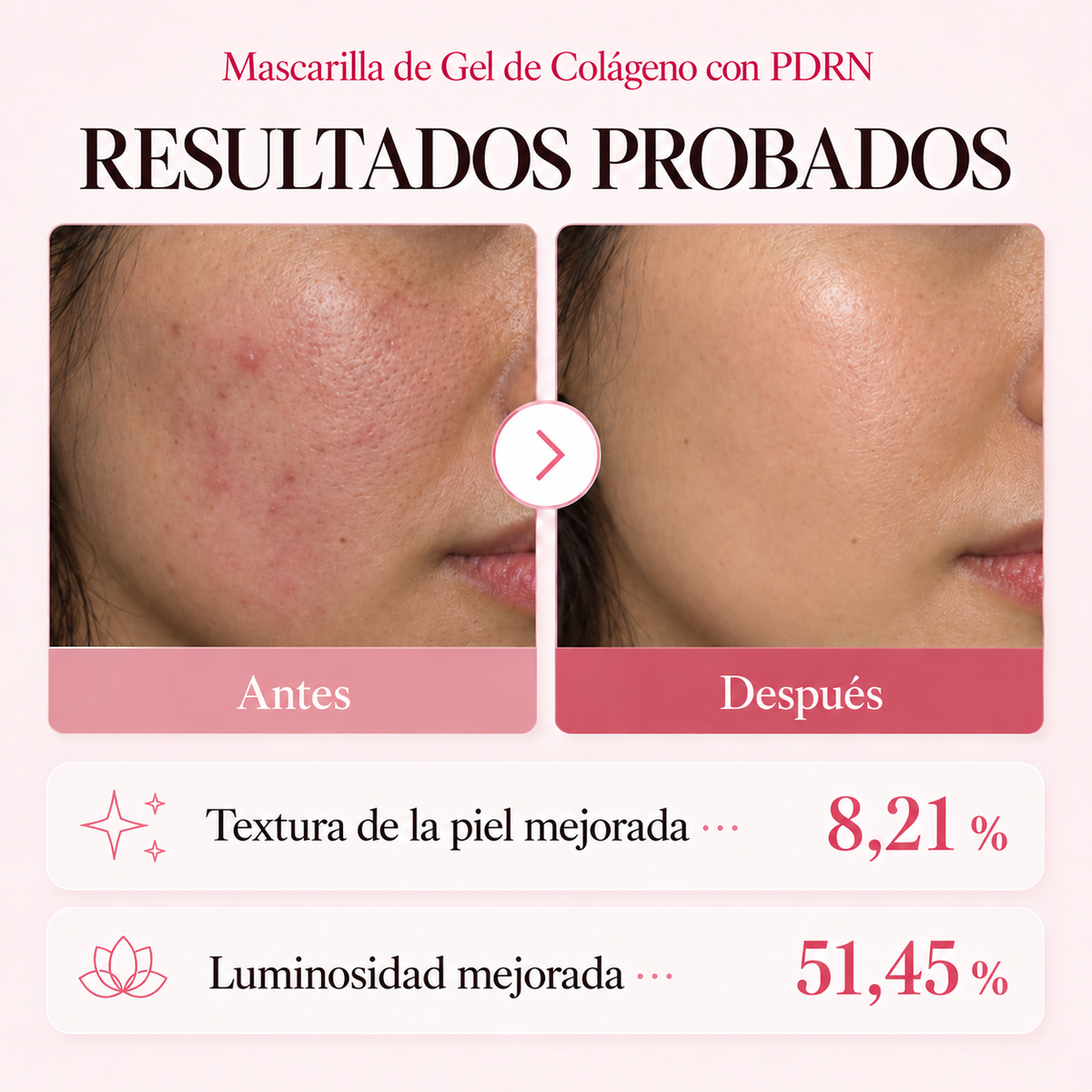 Resultados antes y después de la mascarilla de gel de colágeno con PDRN
